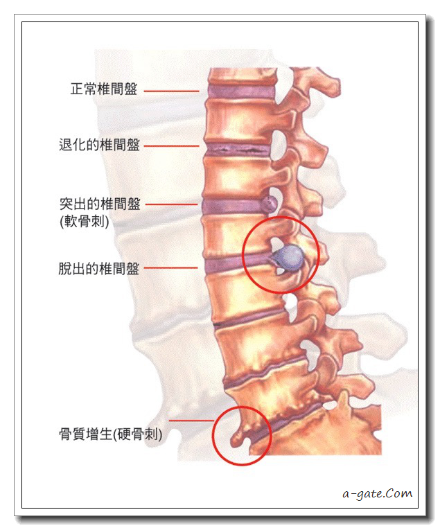 椎間盤突出 vs 貴人紋
