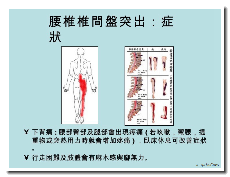 椎間盤突出 vs 貴人紋