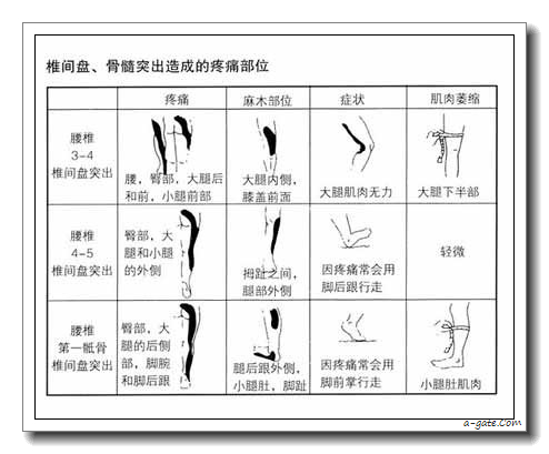 椎間盤突出 vs 貴人紋